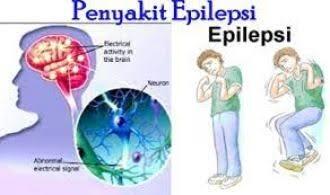 Bagaimana Epilepsi, Bisa Terjadi?