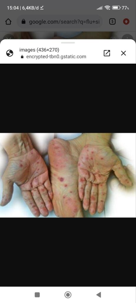 Waspada! Flu Singapura Pada Anak. 