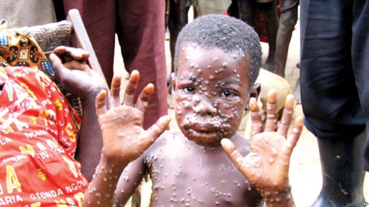 Virus Monyet atau Monkeypox Kini Hantui Kesehatan Dunia