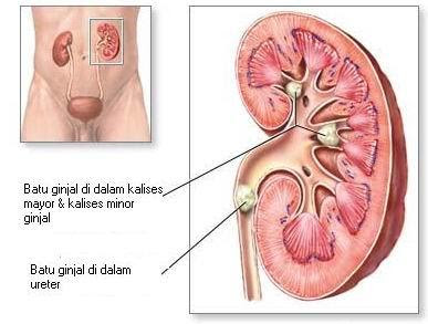 batu+ginjal.JPG