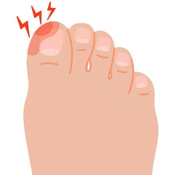 Ingrown Toenails: Kenali Penyebab & Cara Mencegahnya!