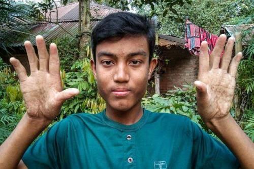 Aneh Tapi Nyata, Keluarga Ini Terlahir Tak Memiliki Sidik Jari?
