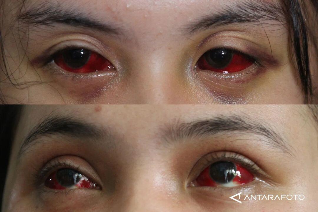 KORBAN LUKA TRAGEDI KANJURUHAN