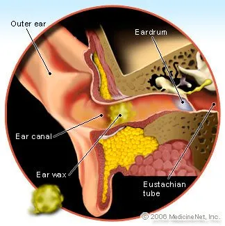 ear_wax.jpg