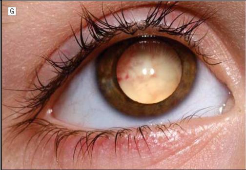 retinoblastoma-awal.jpg