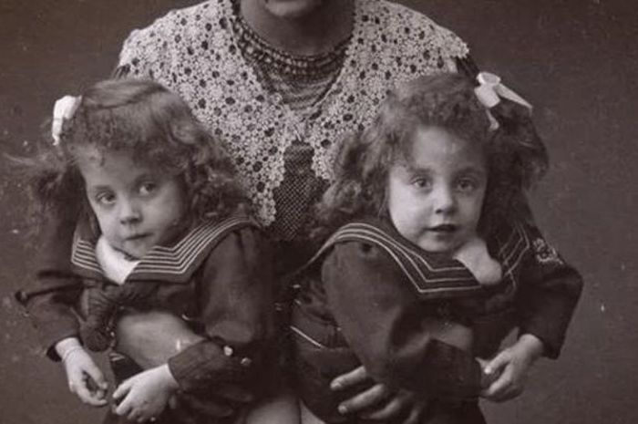 Memilukan, Kisah Saudara Kembar Daisy & Violet Hilton