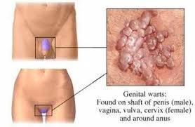 4 Penyakit pada Penis yg Harus kalian Waspadai
