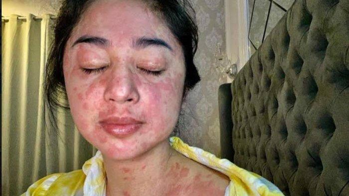 Ini Gejala Covid Variant Baru, Tetap Waspada Yuk