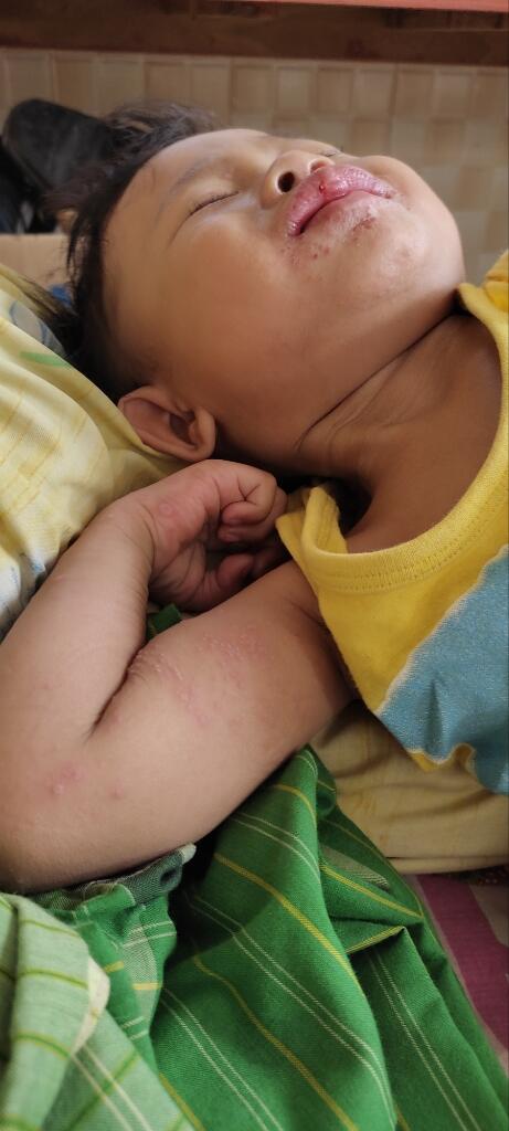 Waspada! Flu Singapura Pada Anak. 