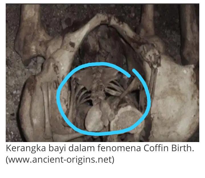 Benarkah Fenomena Coffin Birth Itu Ada? 