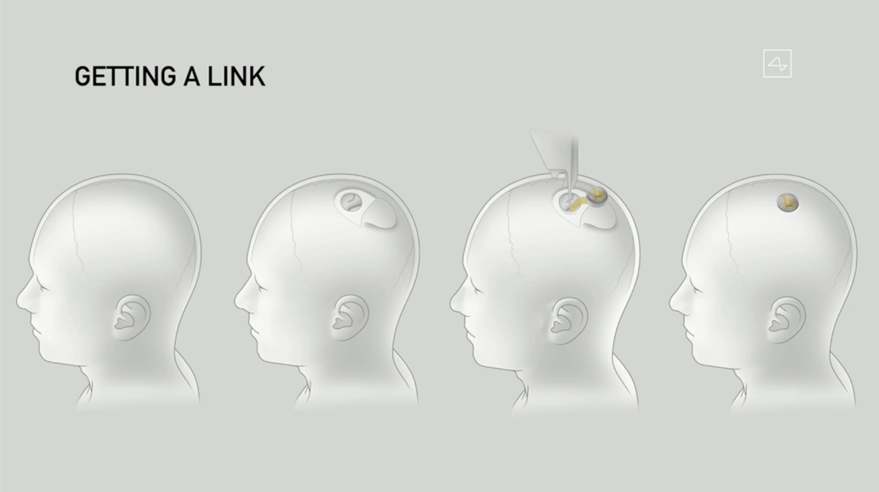 Apa itu Neuralink & Bagaimana Cara Kerjanya ?