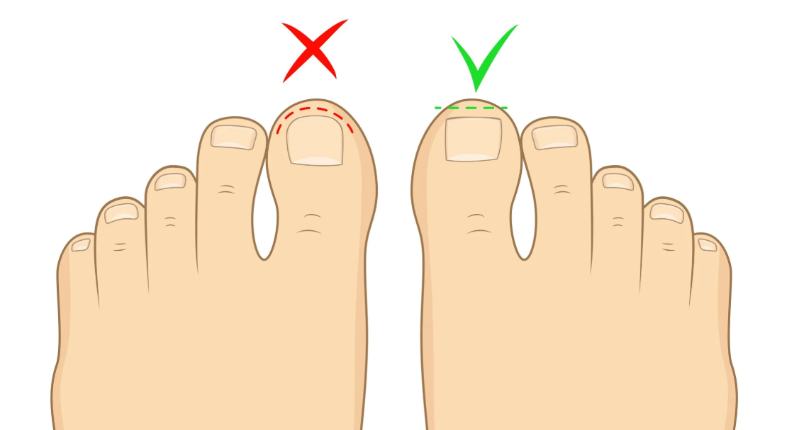 Ingrown Toenails: Kenali Penyebab & Cara Mencegahnya!