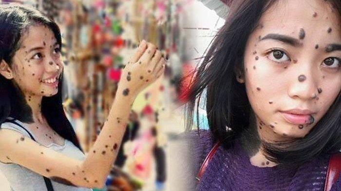 Bintik Di Wajah Kok Disebut Tahi Lalat? 