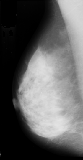 rightBreast3.gif
