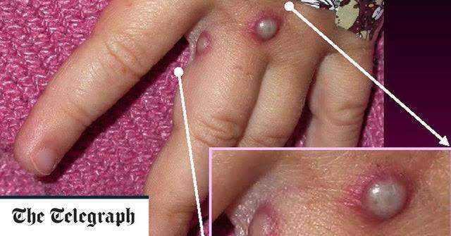 Virus Monyet atau Monkeypox Kini Hantui Kesehatan Dunia