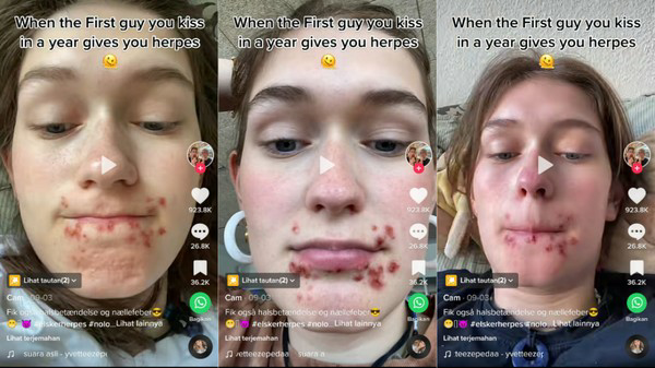 TERKENA HERPES GARA GARA CIUMAN?