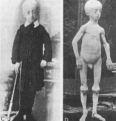 progeria.jpg
